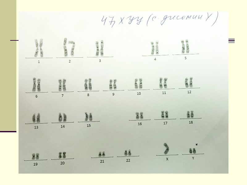 Снд Ангельмана 46, XX (15)(q11.2-q13)  Делеция участка 15й хромосомы от матери  Геномный